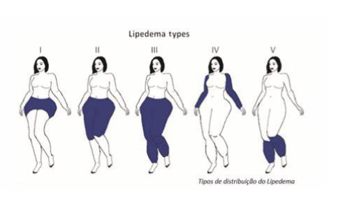 lipedema tipos
